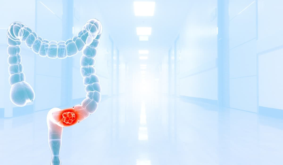 Colorectal Cancer Treatment