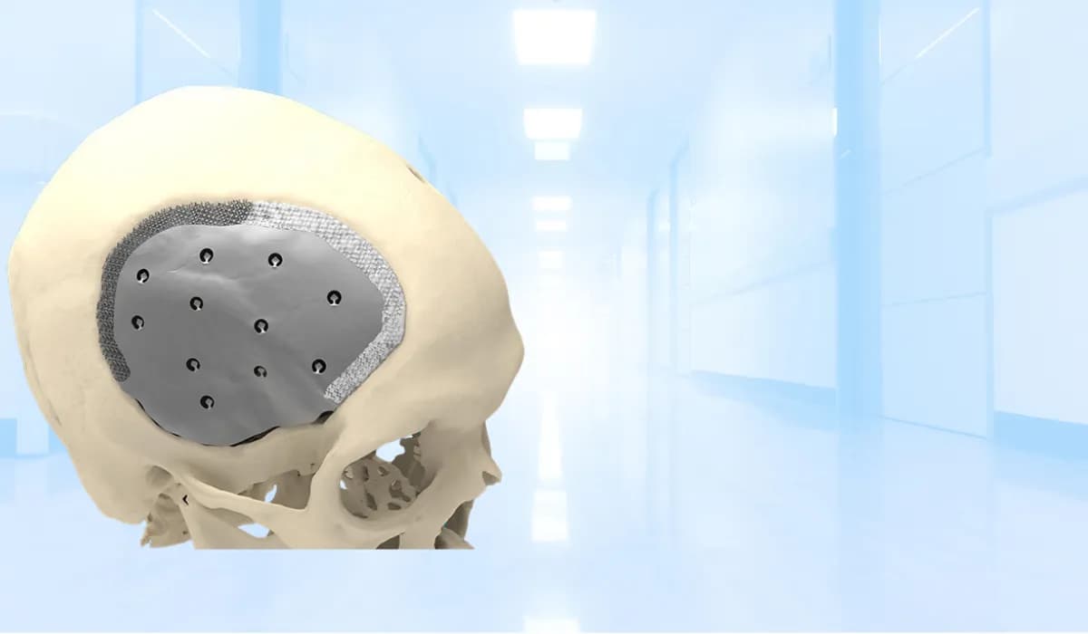 ترميم الجمجمة