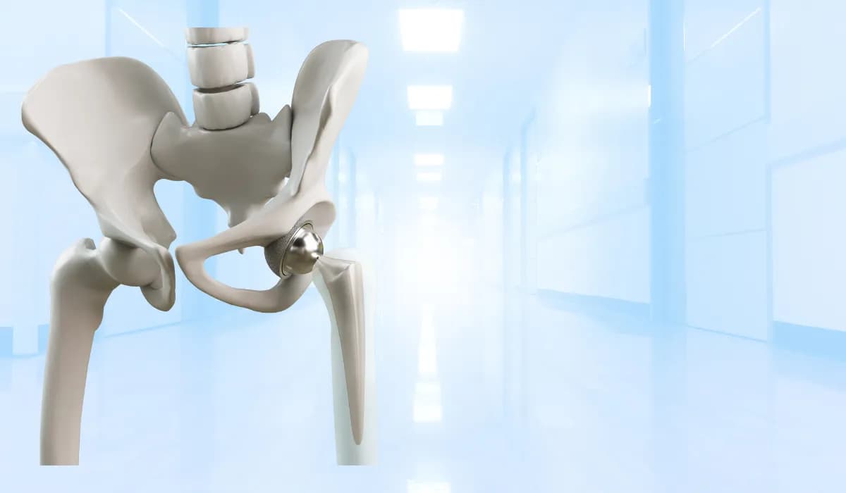 استبدال مفصل الورك