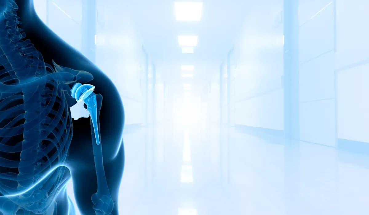 استبدال مفصل الكتف