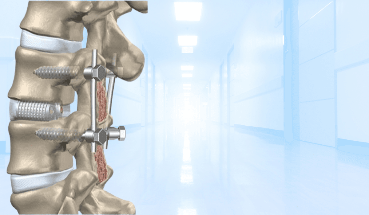 Spinal Fusion Surgery in India