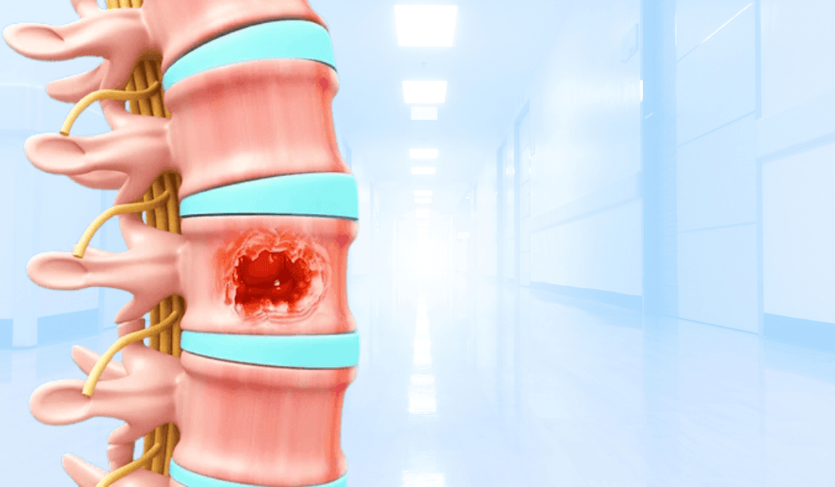 Spine Tumor Removal in India