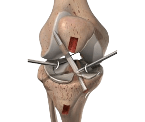 ACL Reconstruction