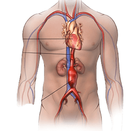 Abdominal Aortic Aneurysm