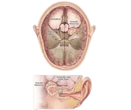 Acoustic Neuroma