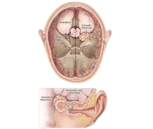 Acoustic Neuroma