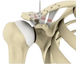 Acromioclavicular Joint Repair