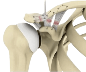 Acromioclavicular Joint Repair