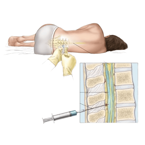 Acute Lymphocytic Leukemia- ALL (Adults)