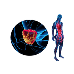 Adenocarcinoma (Glandular Cancer)