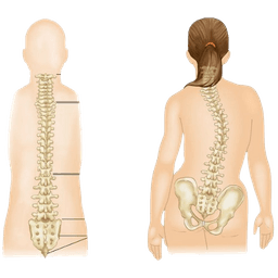 Adolescent Idiopathic Scoliosis