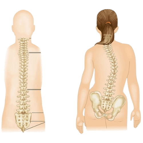 Adolescent Idiopathic Scoliosis