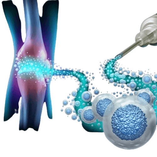 Allogeneic Bone Marrow Transplant