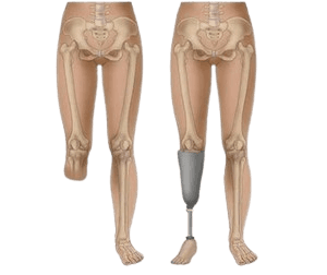 Amputation- Below Knee