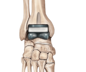 Ankle Replacement