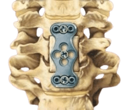 Anterior Cervical Corpectomy