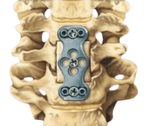 Anterior Cervical Corpectomy