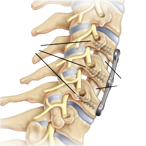 Anterior Cervical Discectomy & Fusion