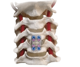 Anterior Cervical Discectomy