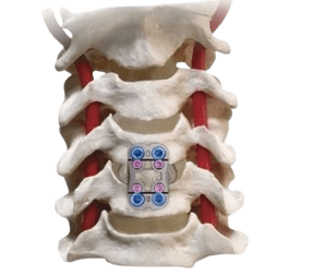 Anterior Cervical Discectomy