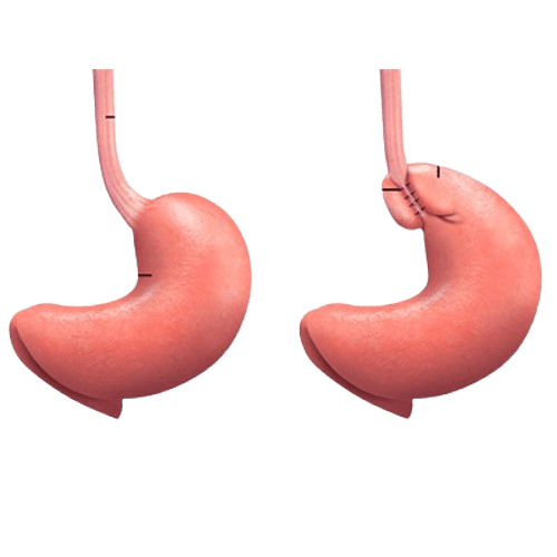 Anti Reflux Procedures