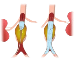 Aortic Stent Grafting