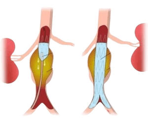 Aortic Stent Grafting