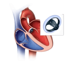 Aortic Valve Replacement