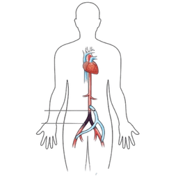 Aortofemoral Bypass Surgery