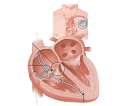 Arrhythmia with Ablation and Pacemaker