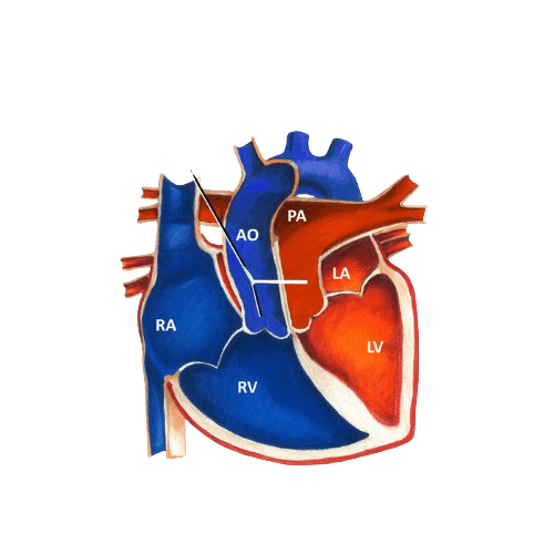 Arterial Switch Operation