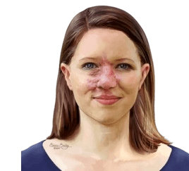 Arteriovenous Malformations