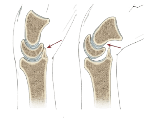 Arthrolysis