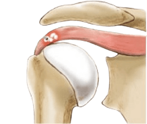 Arthroscopic Debridement Calcium Deposits