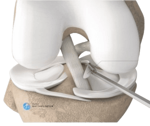 Arthroscopic Meniscectomy