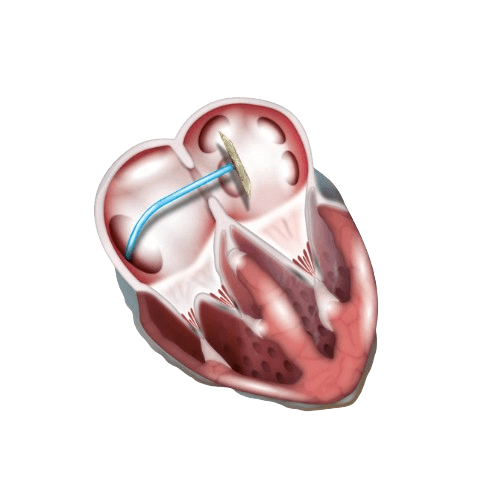 إغلاق العيب الأذيني (ASD)
