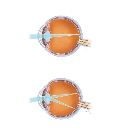 Astigmatism