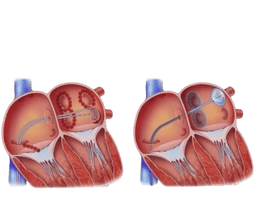 Atrial Fibrillation Surgery
