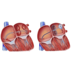 Atrial Fibrillation Surgery