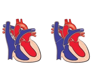 Atrial Septal Defect Closure-ASD