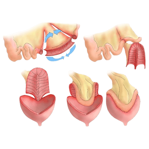 توسيع المثانة (Augmentation Cystoplasty)