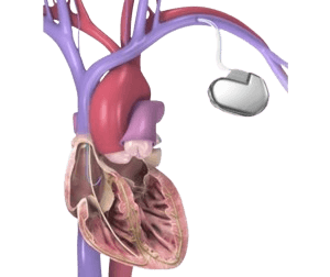 Automatic Implantable Cardioverter Defibrillator (AICD)