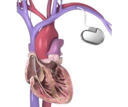 Automatic Implantable Cardioverter Defibrillator (AICD)