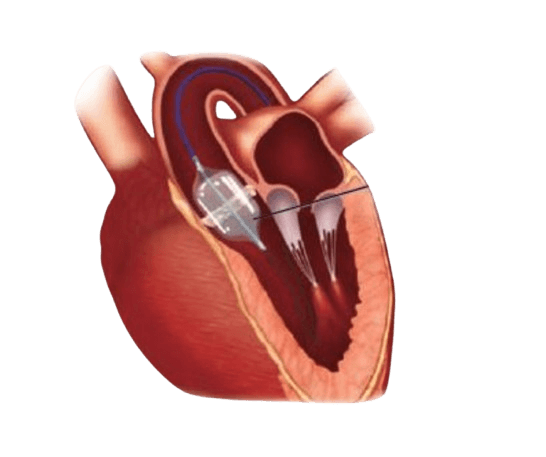 Balloon Valvuloplasty-Aortic