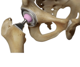 Bilateral Hip Replacement Surgery