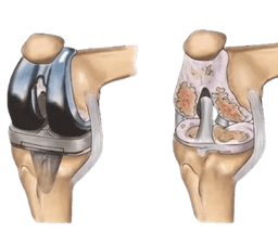 Bilateral Knee Replacement Surgery