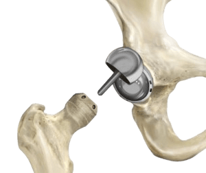 Birmingham Hip Resurfacing Surgery