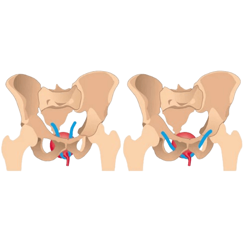 Bladder Slings (TOT & TVT Slings)