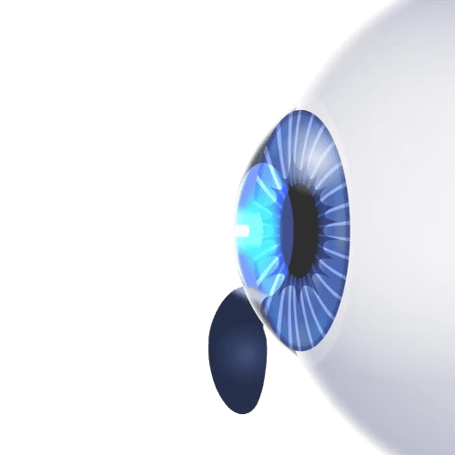 تصحيح البصر بالليزر بدون شفرة (Blade-free LASIK)