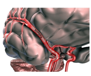 Blood Clot Brain Surgery